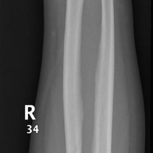 U tế bào khổng lồ