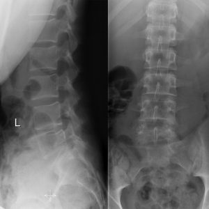 U tế bào khổng lồ