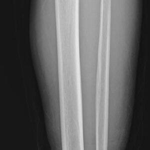 U tế bào khổng lồ