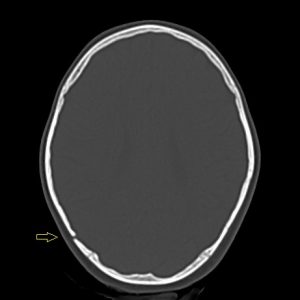 Vỡ xương đỉnh phải