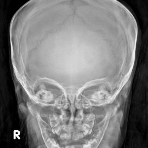 Vỡ xương trán + xương thái dương phải