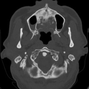 Vỡ xương chẩm phải