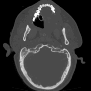 Vỡ xương nền sọ