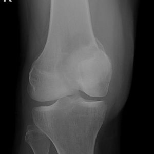 U tế bào khổng lồ