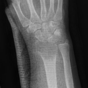 U tế bào khổng lồ