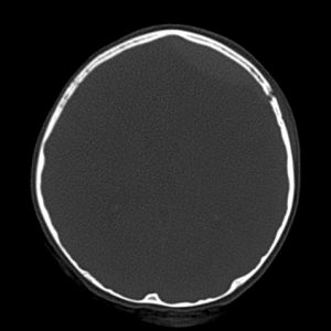 Vỡ xương hộp sọ