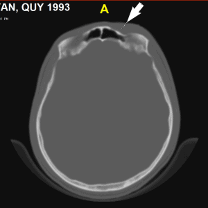 Vỡ xương hộp sọ