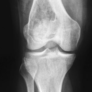 U tế bào khổng lồ