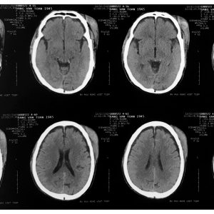 Vỡ xương hộp sọ