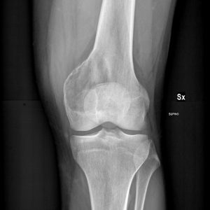 U tế bào khổng lồ