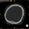 Coronal