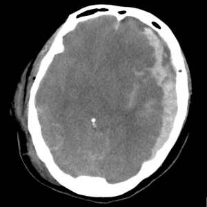 Chấn thương sọ não