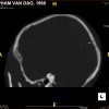 Sagittal