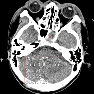 Vỡ xương nền sọ
