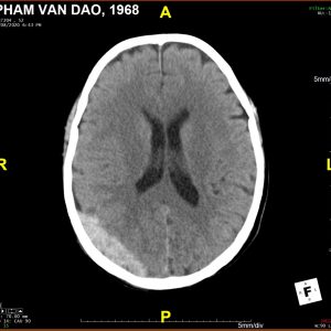 Chấn thương sọ