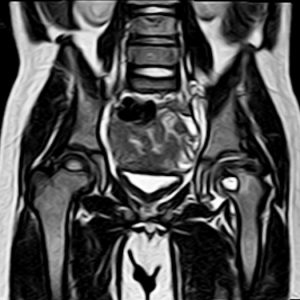 Dẹt chỏm xương đùi