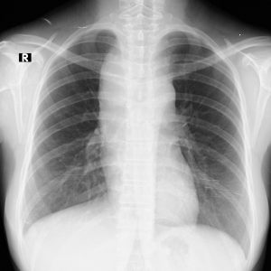 Lymphoma trung thất