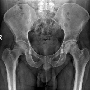 Hoại tử xương vô khuẩn