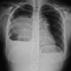 Lymphoma trung thất