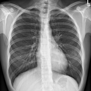 Nang thực quản đôi