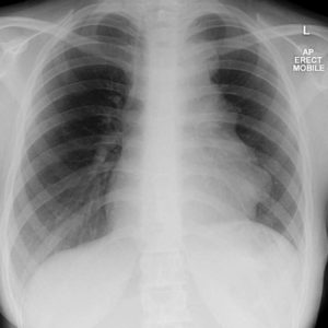 Lymphoma trung thất
