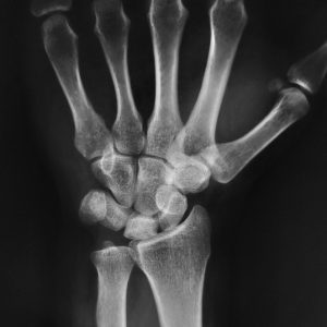 Hoại tử xương vô khuẩn