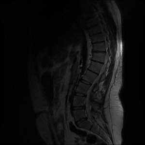 Viêm CS dính khớp