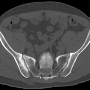 Viêm cột sống dính khớp