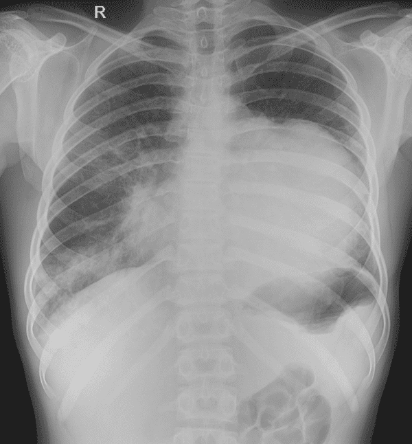 Lymphoma trung thất