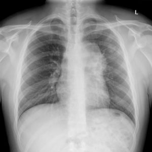 Lymphoma trung thất