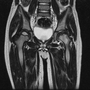 Dẹt chỏm xương đùi