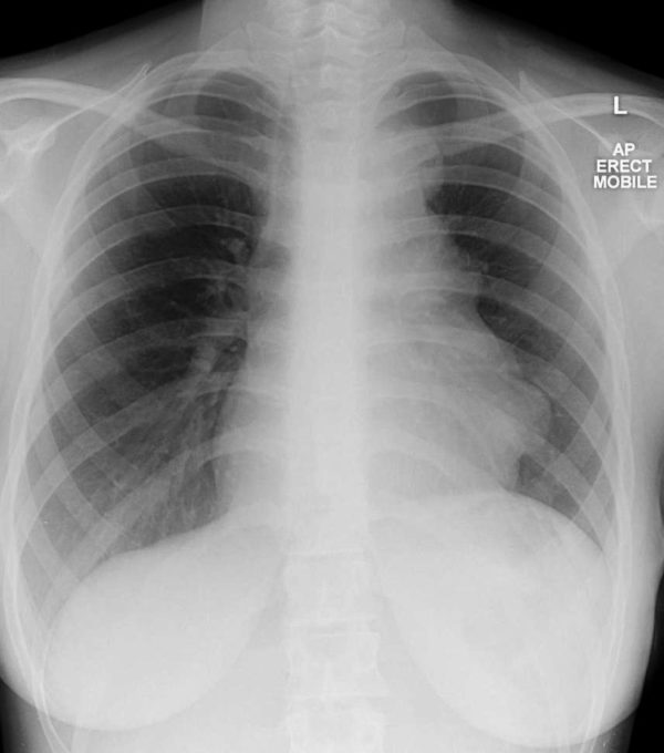 Lymphoma trung thất