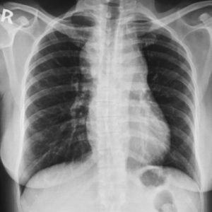Lymphoma trung thất