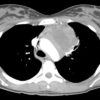 Lymphoma trung thất - Hình ảnh 2