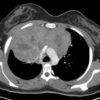 Lymphoma trung thất - Hình ảnh 3