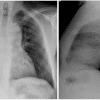 Lymphoma - Hình ảnh 2