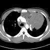 Lymphoma trung thất - Hình ảnh 2