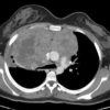 Lymphoma trung thất - Hình ảnh 4