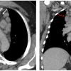 Lymphoma - Hình ảnh 3