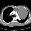 Lymphoma trung thất - Hình ảnh 3