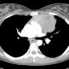 Lymphoma trung thất - Hình ảnh 4