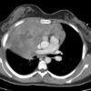 Lymphoma trung thất - Hình ảnh 5