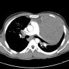 Lymphoma trung thất - Hình ảnh 4