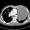 Lymphoma trung thất - Hình ảnh 5