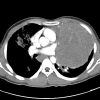 Lymphoma trung thất - Hình ảnh 6