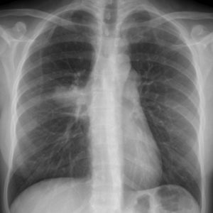 Lymphoma trung thất