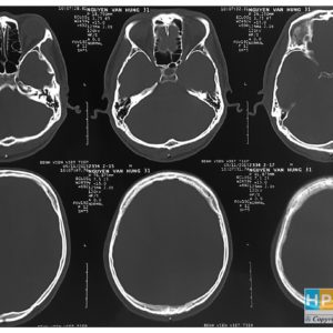 Chấn thương sọ não