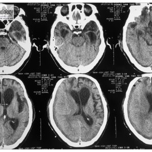 Chấn thương sọ não