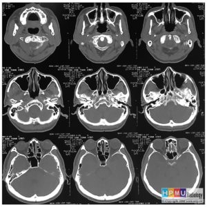 Viêm xoang hàm mặt