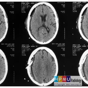 Chấn thương sọ não